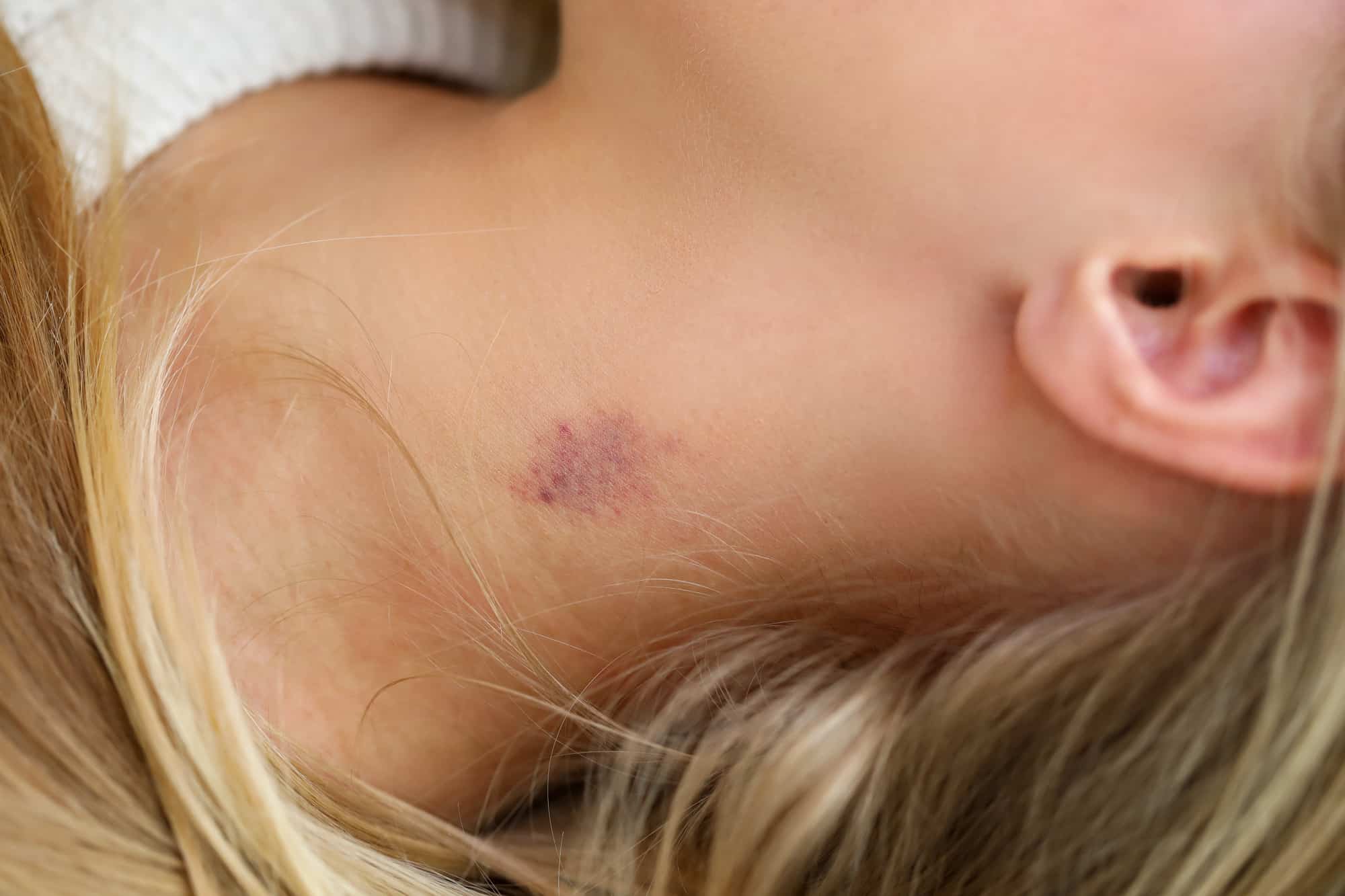 Are bad why hickies What Does